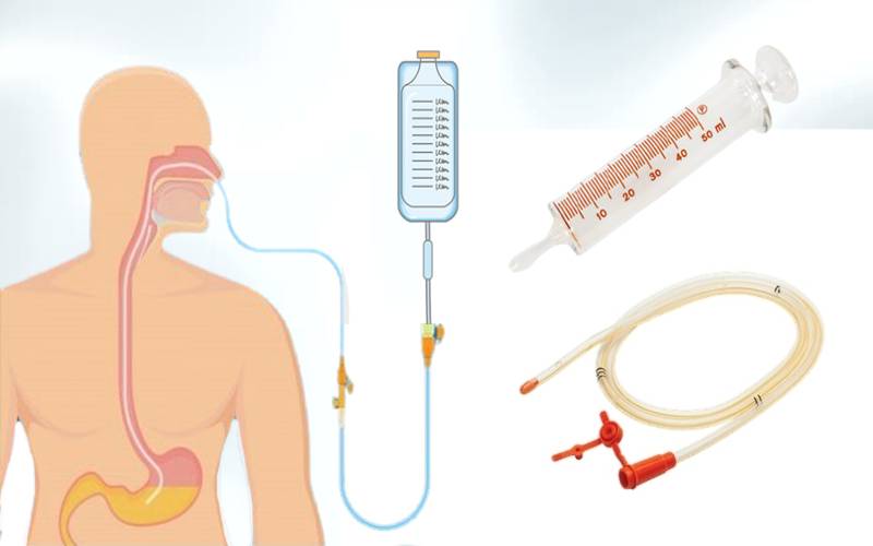 Feeding Tube: Its Uses, Types and the Methods of Removal