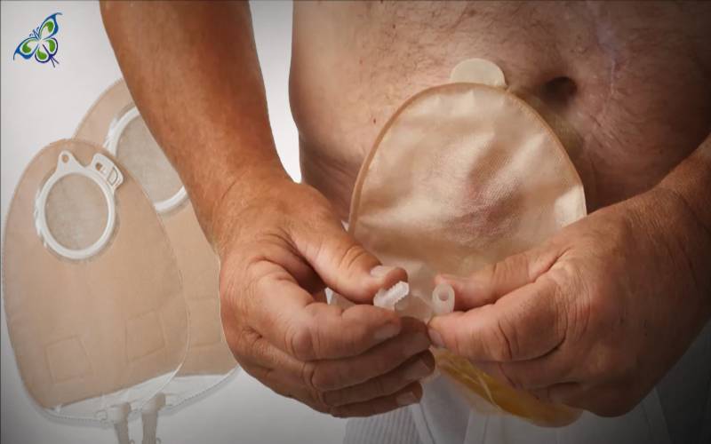 Urostomy? One-piece Urinary Pouch to the Rescue
