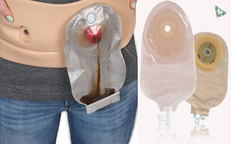 Vexed With The Smelly Urostomy Pouch? Here Are Some Solutions...